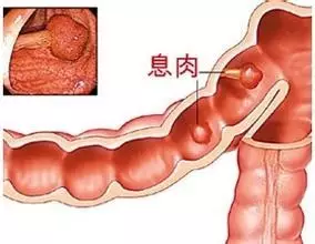 肠息肉癌变的时间因素，深度解析肠息肉与癌变之间的关联